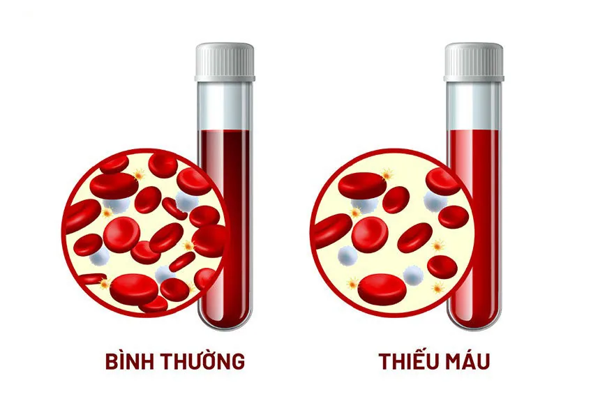 Khi mang thai, nếu mẹ không nạp đủ sắt, quá trình tạo hồng cầu bị ảnh hưởng và dễ dẫn đến thiếu máu.